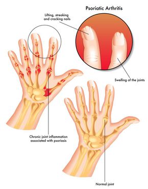 artrite simptome și tratament artroză)